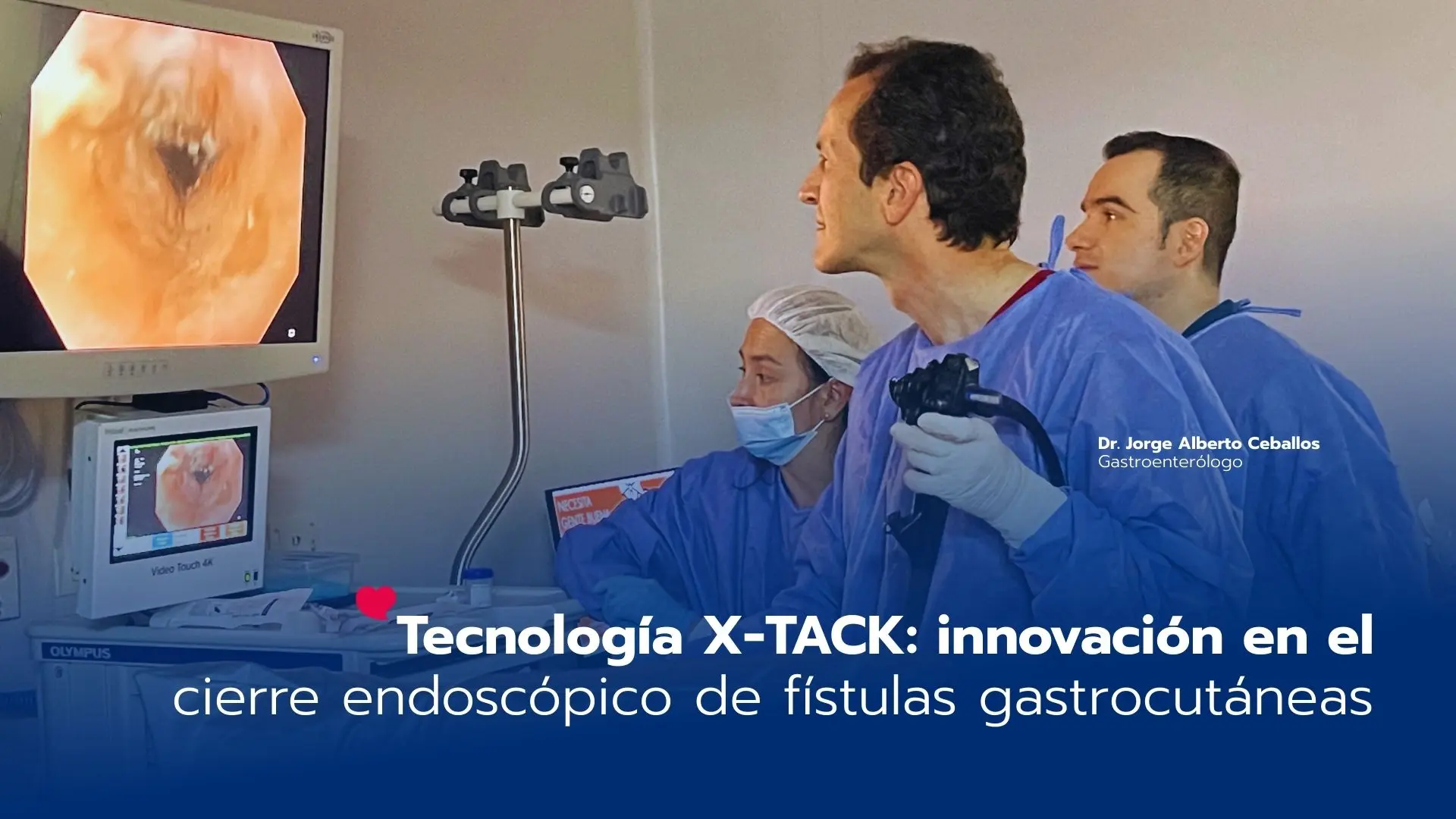 Cierre endoscópico innovador de fístula gastrocutánea con sutura X-TACK: tecnología que transforma la experiencia de nuestros pacientes