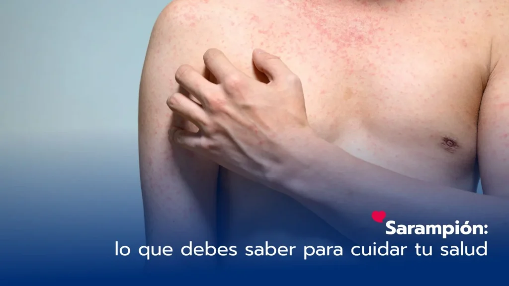 Sarampión: lo que debes saber para proteger tu salud