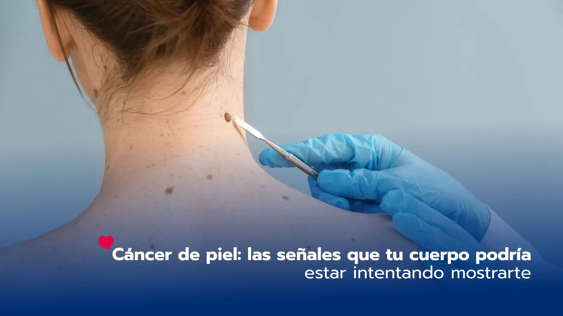 Cáncer de piel: las señales que tu cuerpo podría estar intentando mostrarte
