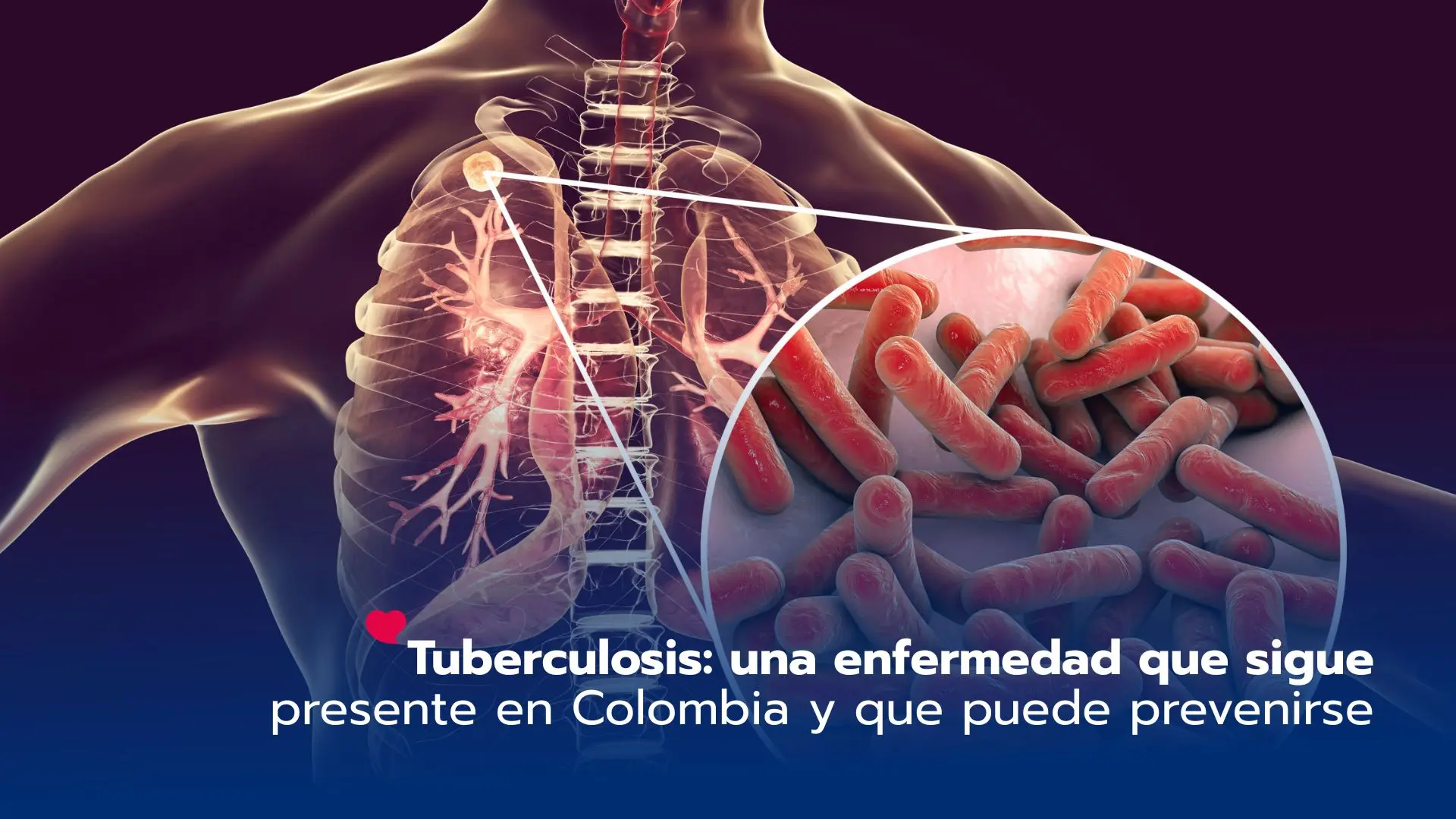 ¿La tuberculosis sigue siendo un problema en Colombia? Lo que todos debemos saber para prevenirla