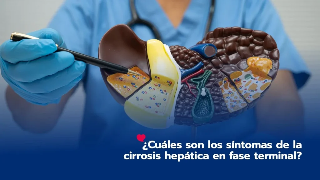 ¿Cuáles son los síntomas de la cirrosis hepática en fase terminal?