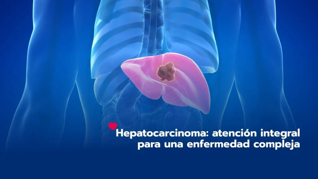 Hepatocarcinoma: atención integral para una enfermedad compleja
