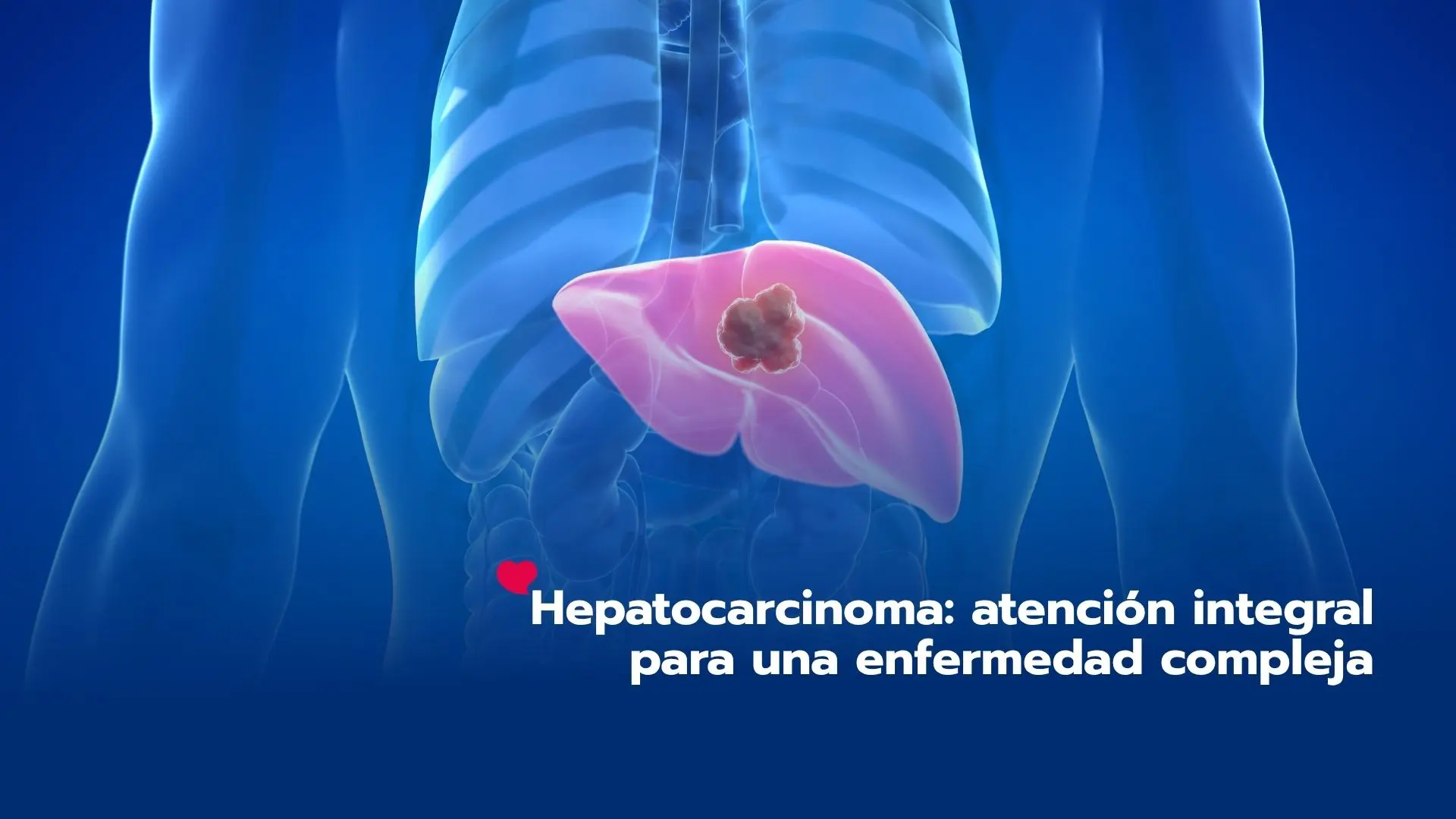 Hepatocarcinoma: atención integral para una enfermedad compleja
