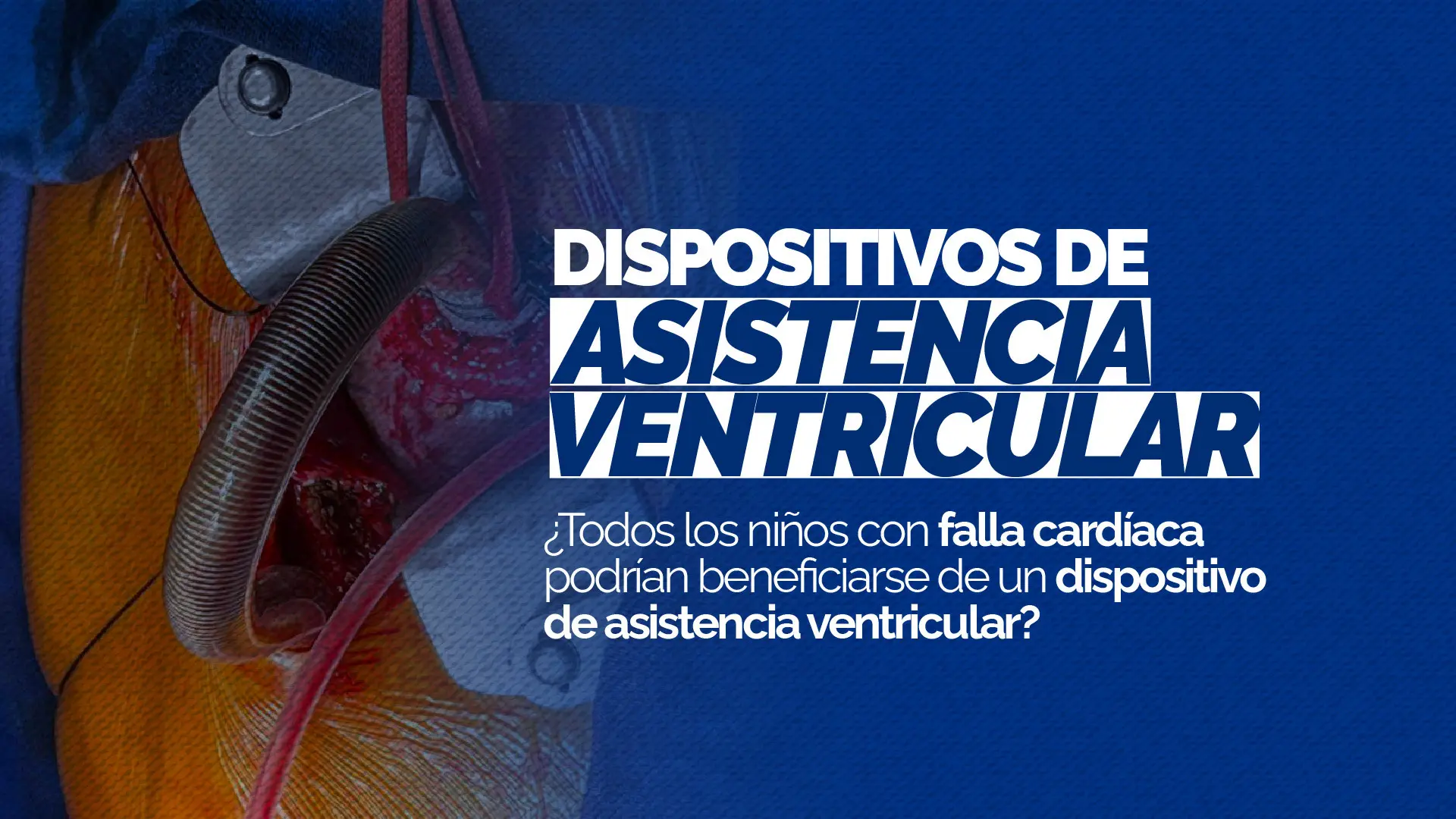 ¿Todos los niños con falla cardíaca podrían beneficiarse de un dispositivo de asistencia ventricular?